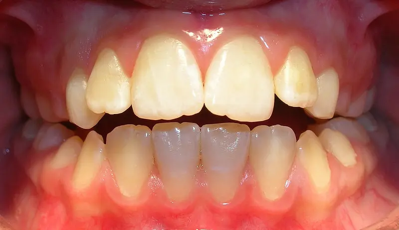 dientes flor de lis - Cómo se llama los dientes del fondo